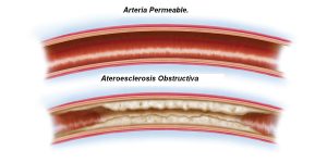 Arterial Disease