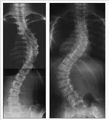 Radiografía Escoliosis