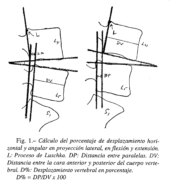 Inestabilidad de la Columna Lumbar. - Consulta Médica del Dolor ...