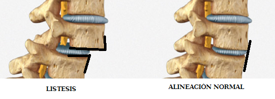 Inestabilidad de la Columna Lumbar. - Consulta Médica del Dolor ...