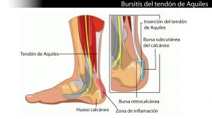 Bursitis-RetroAquilea y Retrocalcánea
