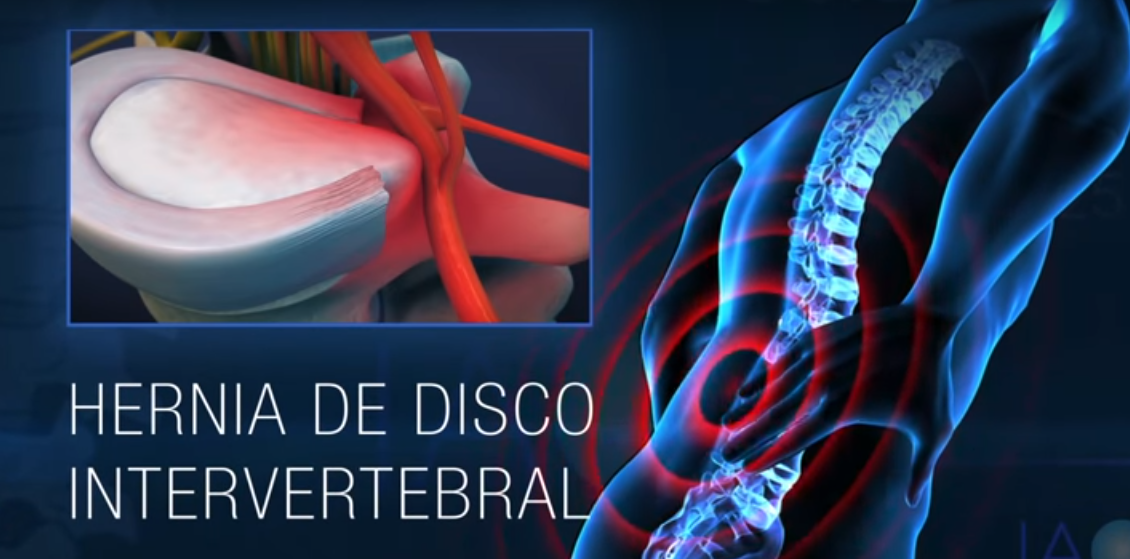 Hernia Discal En Columna ¿que Significa Consulta Médica Del Dolor Granadacentro Médico Del 7103